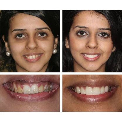 🔥Last Day Promotion 49% OFF🔥-Teeth Whitening Essence